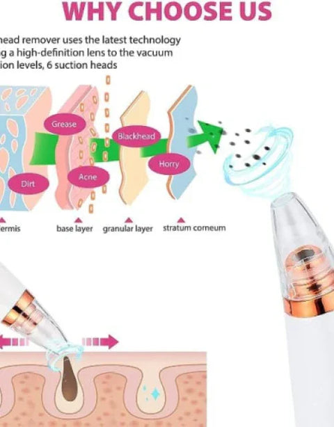 6 in 1 Multi-function Blackhead Remover Tools - BUYSQUARE